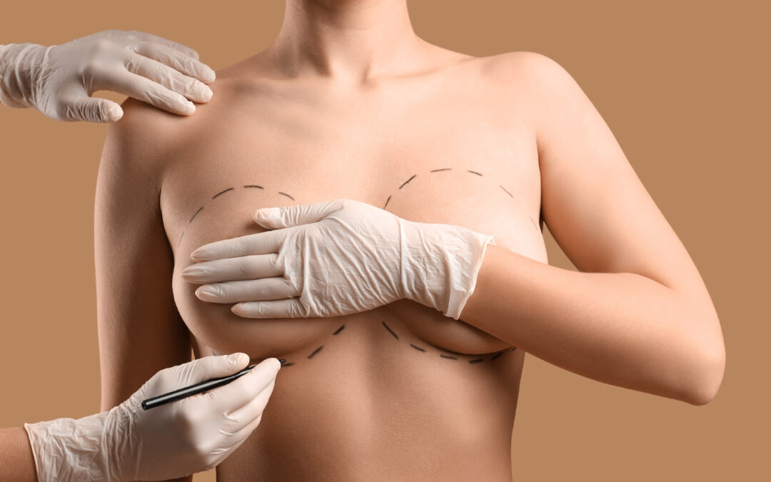 Correction des seins tubéreux : quelles solutions chirurgicales pour retrouver une poitrine harmonieuse ?